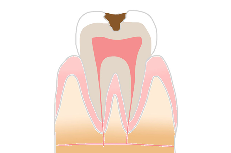 象牙質のむし歯「C2」