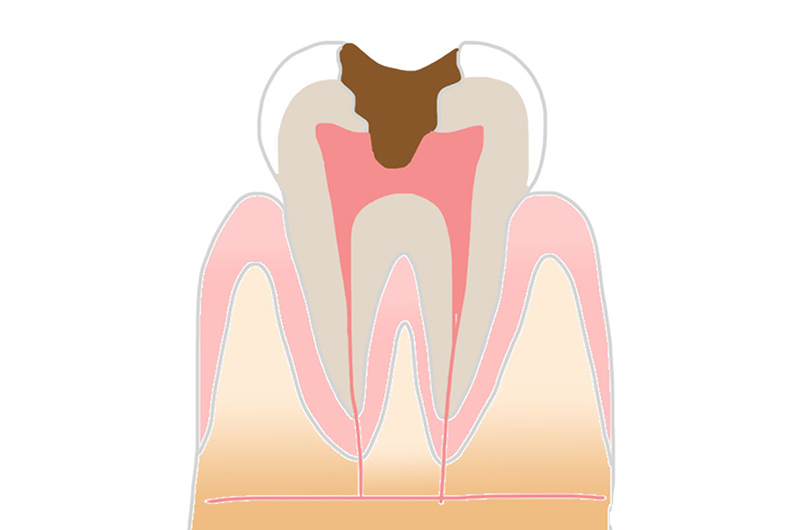 神経まで進んだむし歯「C3」