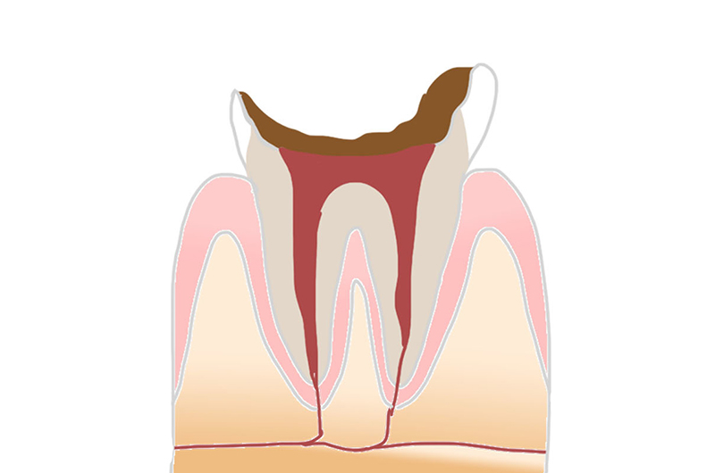 むし歯で歯が崩壊した状態「C4」