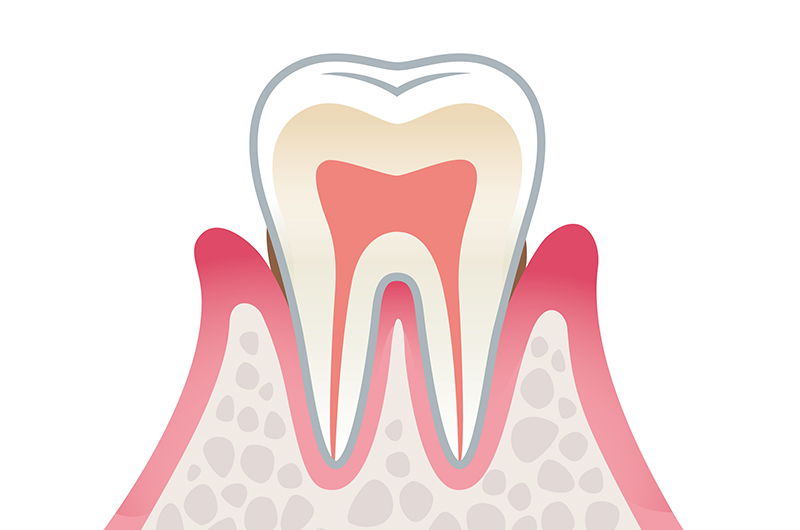 軽度の歯周病
