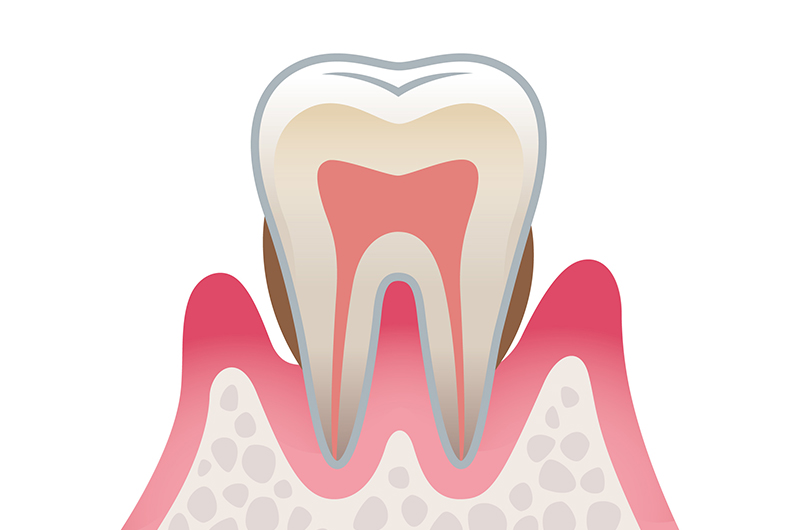 中等度の歯周病
