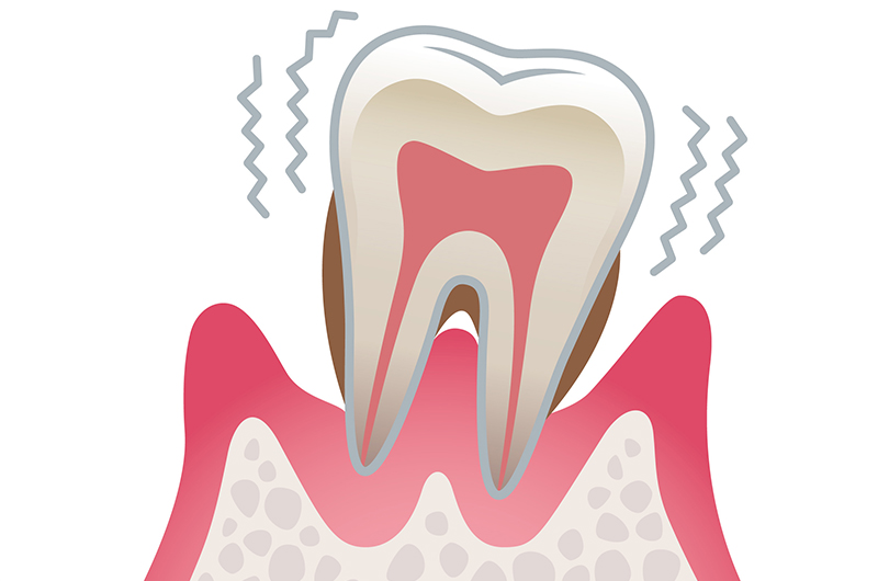 重度の歯周病