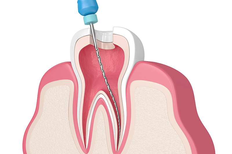 根管治療